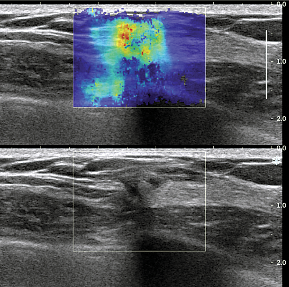 Suspicious mass first identified at screening mammography Suspicious mass first identified at screening mammography